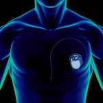 Michigan-University-Cardiac-pacemakers-battery