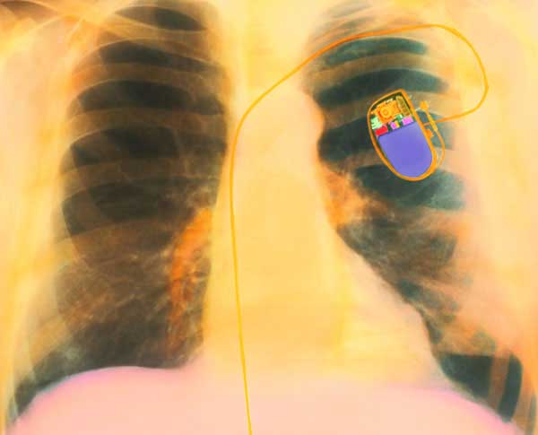 Pacemakers--heartbeat-vibrations-energy