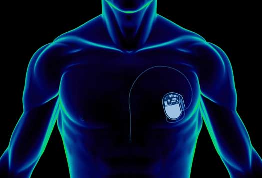 Michigan University Cardiac pacemakers battery